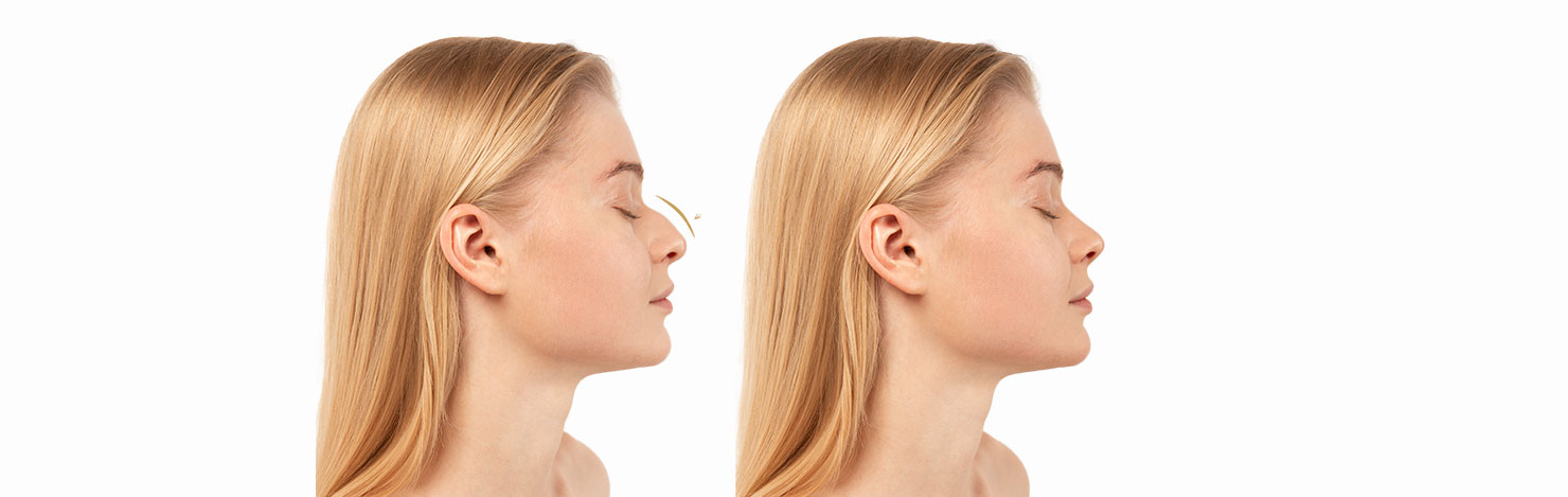 antalya burun estetigi