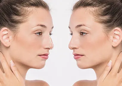 Antalya'da Rinoplasti Ameliyatı