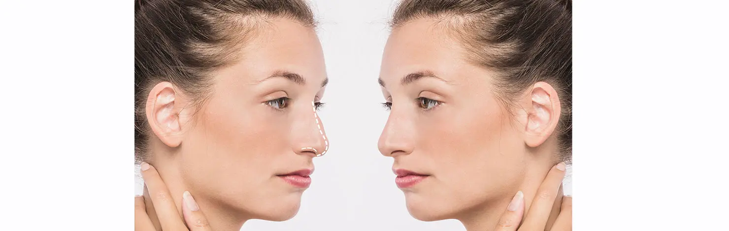 Antalya burun estetiği öncesi sonrası örnek