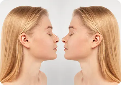 Antalya'da Rinoplasti Ameliyatı